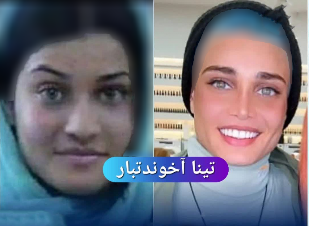 عکس بازیگران زن ایرانی قبل و بعد از عمل زیبایی