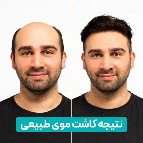قبل و بعد از کاشت موی طبیعی