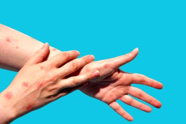 همه چیز درباره آبله میمون + علائم